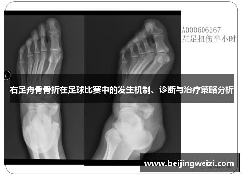 右足舟骨骨折在足球比赛中的发生机制、诊断与治疗策略分析